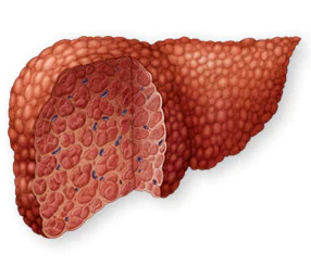Liver Transplant